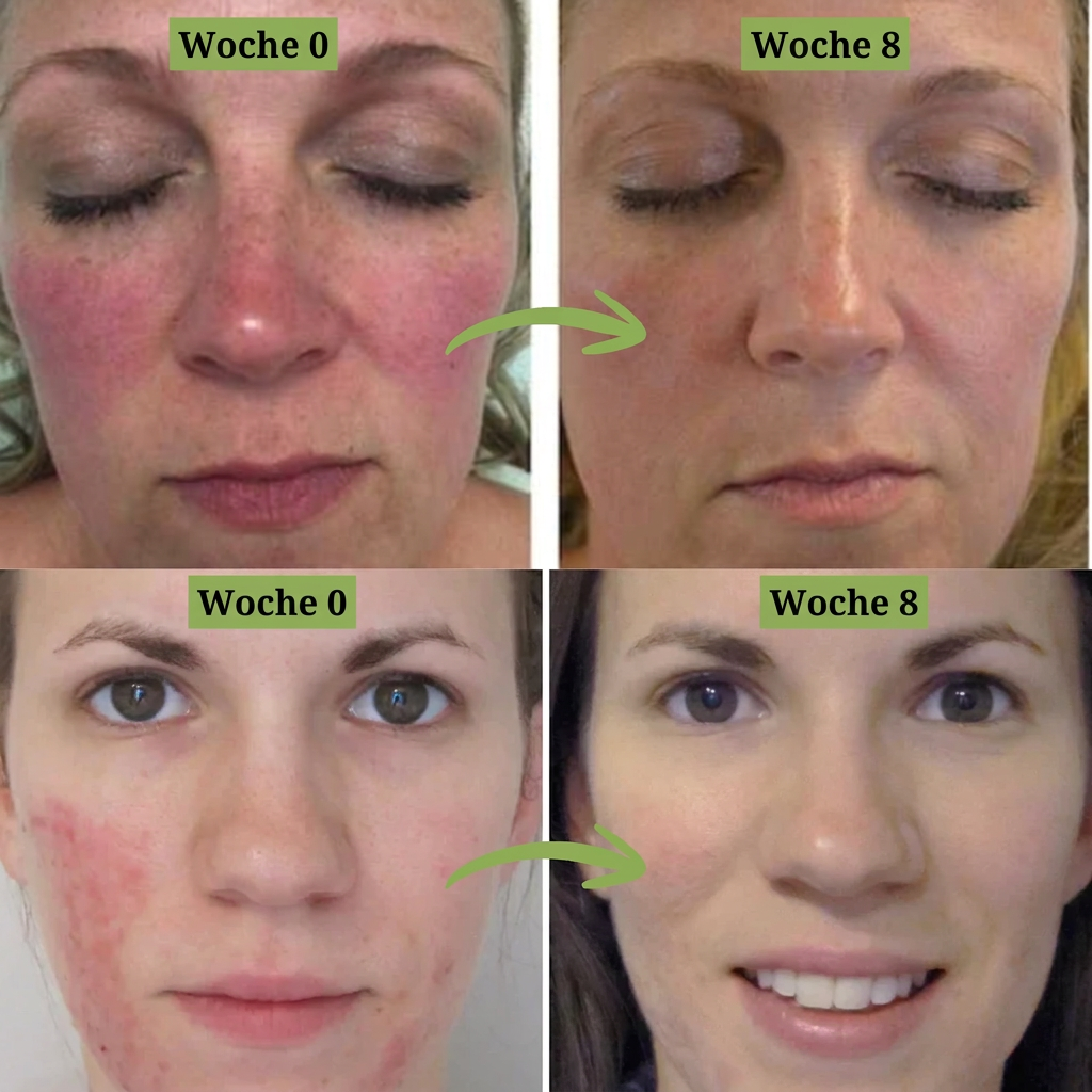 SkinClear™ Serum gegen Rötungen (30 ml)
