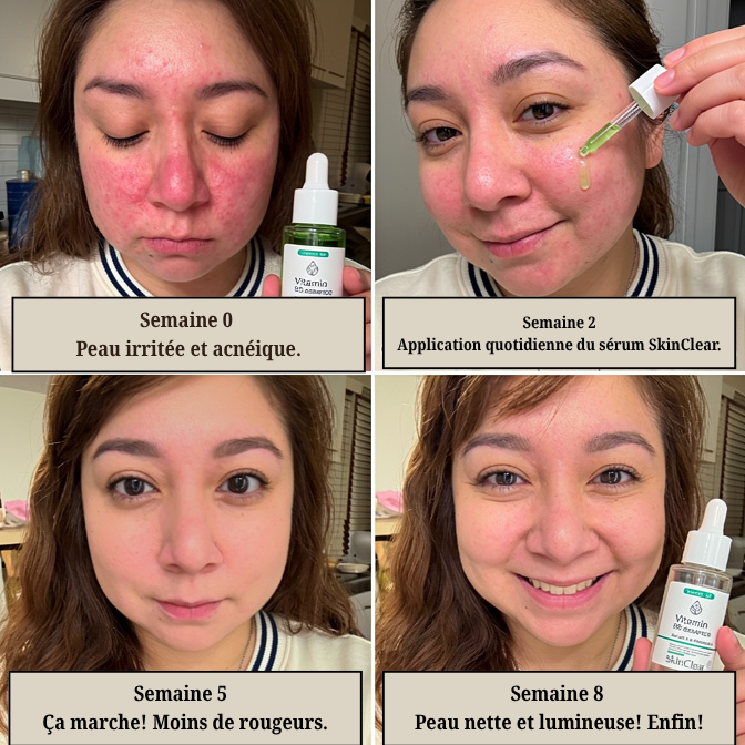 SkinClear™ Sérum Anti-Rougeurs