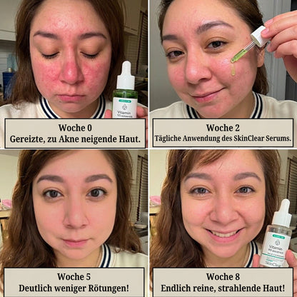 SkinClear™ Serum gegen Rötungen (30 ml)