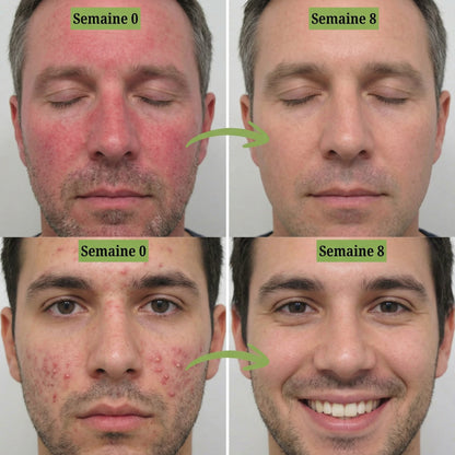 SkinClear™ Sérum Anti-Rougeurs (30ML)